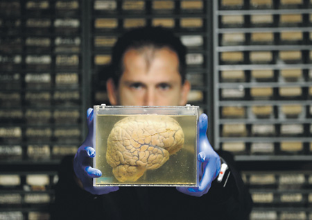 человеческий мозг, болезнь паркинсона