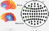 Новости науки. Как электрическая стимуляция мозга влияет на усвоение новых слов
